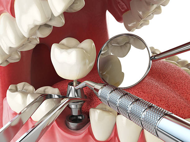 Best Emergency Dental Care for Abscessed Tooth in Perry, MI